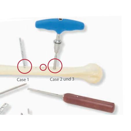 Screw Removal Set